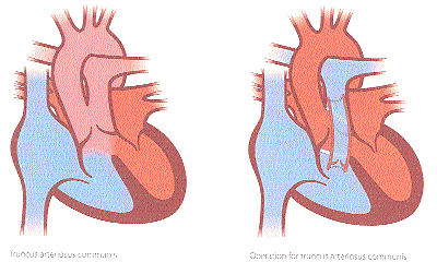Tegning af truncus-hjertet før og efter operation