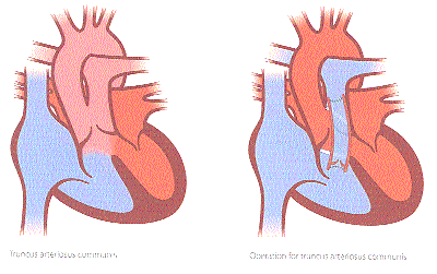 Tegning af truncus-hjertet fr og efter operation